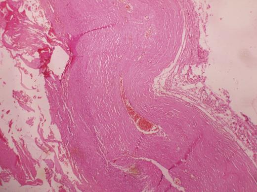 Histopathological slide showing the absence of lining epithelium.