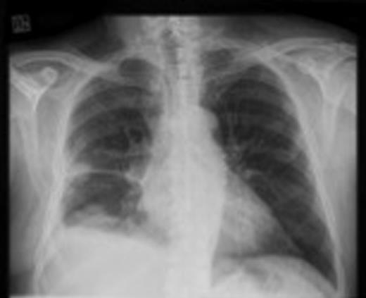 Chest X-ray showing right pleural effusion.