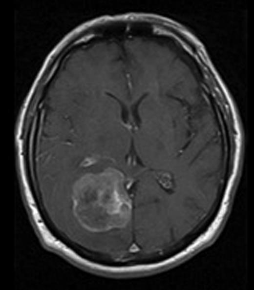 MRI image of brain with gadolinium contrast showing enhancing mass in the right occipital lobe.
