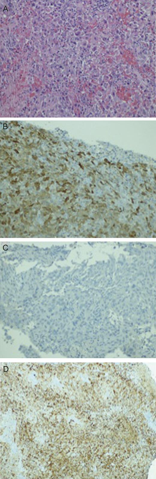 (A) H&E stain of the brain lesion. (B) Positive caltritinin stain. (C) Negative HBME1 stain. (D) Positive C5/6 stain.