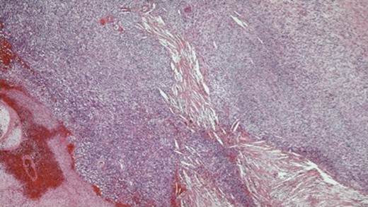 Photomicrograph ×4 H&E; spindle cell tumour with areas of haemorrhage and necrosis.