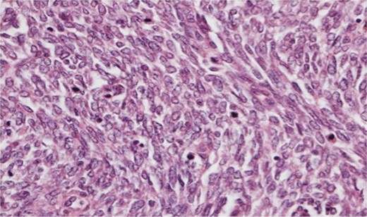 Photomicrograph ×40 H&E; pleomorphic spindle cells in fascicles with several mitoses.