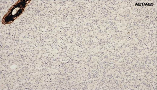 Photomicrograph showing negative cytokeratin AE1/AE3 staining in spindle cells.