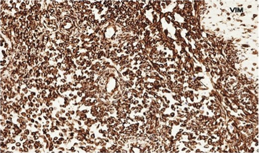 Photomicrograph showing vimentin-positive spindle cells.