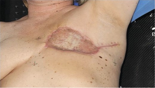 Postoperative photograph demonstrating split thickness skin graft reconstruction.