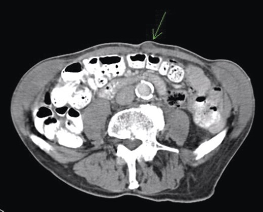 The presenting umbilical nodule as seen on CT in 2008.