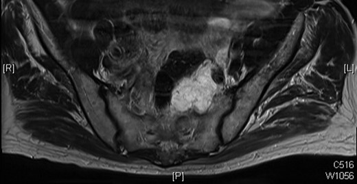MRI scan of 2009 showing a mucinous mass in the left side of the pelvis below the anastomosis from his original sigmoid colectomy.