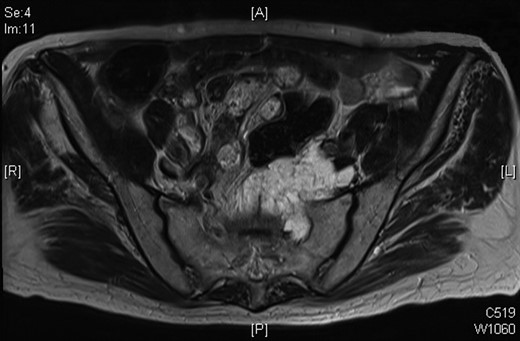 Progression of the mucinous mass on MRI in 2012. On repeated PET scanning, the mass shows minimal cellular activity.