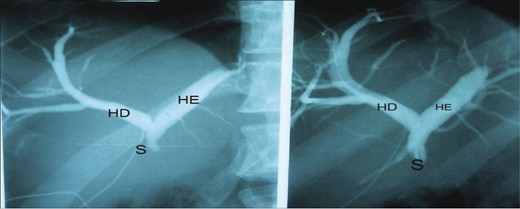 Right hepatic duct (RH), left hepatic duct (LH) and obstructed common hepatic duct (O).