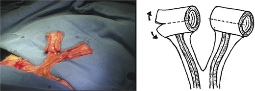 Sectioned segments of the jejunal loop.