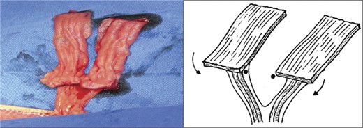 Pedicled ‘rectangle’.