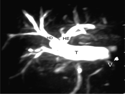Right hepatic duct (RH), left hepatic duct (LH), interposed jejunal tube (T) and antireflux valve (V).