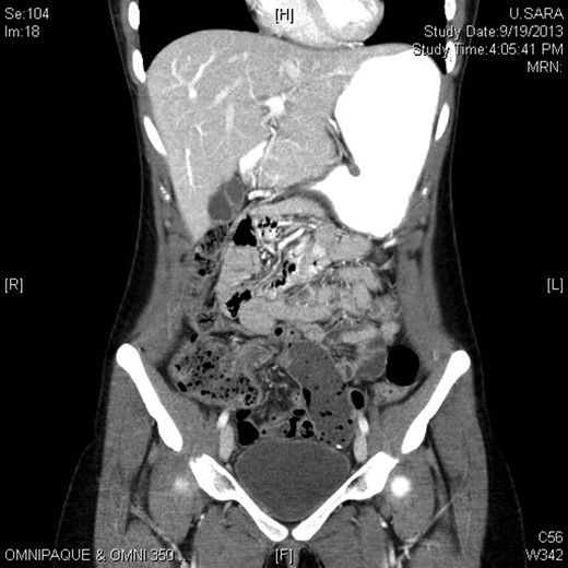 Image from CT scan showing a transition point in the right lower quadrant.