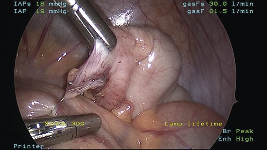 Staple bridging appendiceal stump staple line and loop of small bowel creating an internal hernia.
