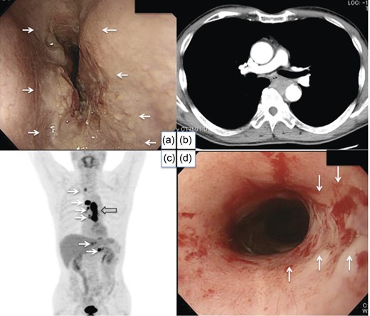 Pretreatment endoscopic examination, CT scan, FDG-PET and post-treatment endoscopic examination. A tumor was found in the middle thoracic esophagus (a). CT scans revealed possible invasion of the aorta (b) and multiple lymph node metastases. FDG-PET also suggested the spread of tumors (open arrow) and multiple lymph node metastases (white arrows) (c). Post-treatment endoscopy showed a marked reduction in the size of the tumor, while residual carcinoma cells were detected in a biopsy specimen (white arrows) (d).