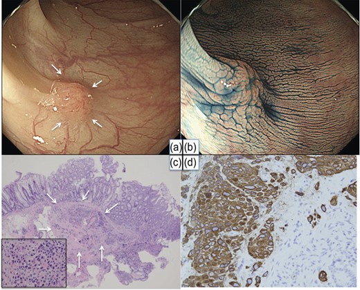 Colonoscopy and histology of a biopsy specimen. A small elevated lesion was found at the site of the splenic flexure (white arrows) (a and b). Hematoxylin–eosin staining and CK14 staining (c and d).