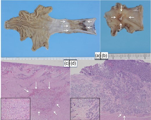 Macroscopic and microscopic findings of resected esophagus and colon. A flat tumor was found in the esophagus (white arrows) (a). A 1.0-cm submucosalcolonic tumor was excised (white arrows) (b). Remnant viable cells were observed in the esophagus (white arrows) and lymph nodes (c). Colonic metastasis was located in the submucosa and slight invasion of the muscularispropria was observed (white arrows) (d).