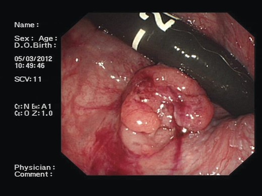 A colonoscopic image demonstrating ∼1-cm polypoid mass at the ano-rectal junction.