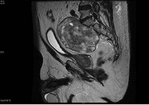 The 10 × 15 cm pre-sacral pelvic mass on sagittal contrast CT.