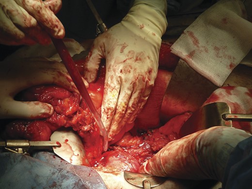 Image of the pelvic mass with the sigmoid reflected.