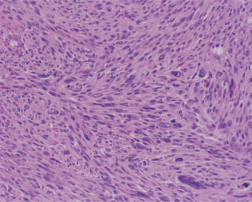 Cross section at low power. Intersecting bundles. Multinucleated giant cell in the bottom right.