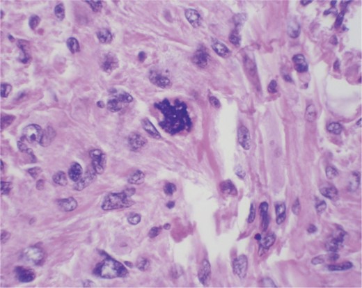 High power. Bizarre nuclei. High mitotic activity.