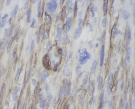 Immunostain with SMA (smooth muscle actin). Positive cytoplasmic staining indicating smooth muscle origin.