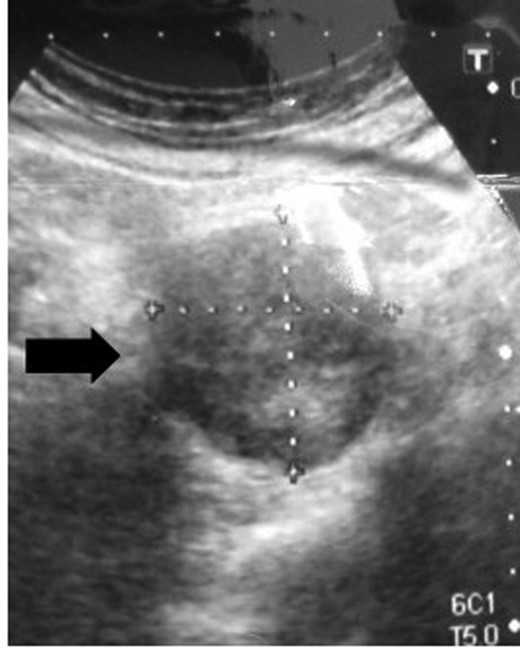 Ultrasonography of the pelvis shows a 5 × 4.3 cm solid and an iso-echoic mass.