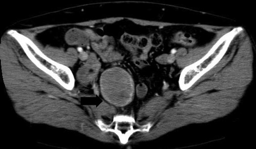 Contrast enhanced-CT shows a 5 × 4 cm solid, well-defined, heterogeneous mass in the right side of the pelvic cavity.