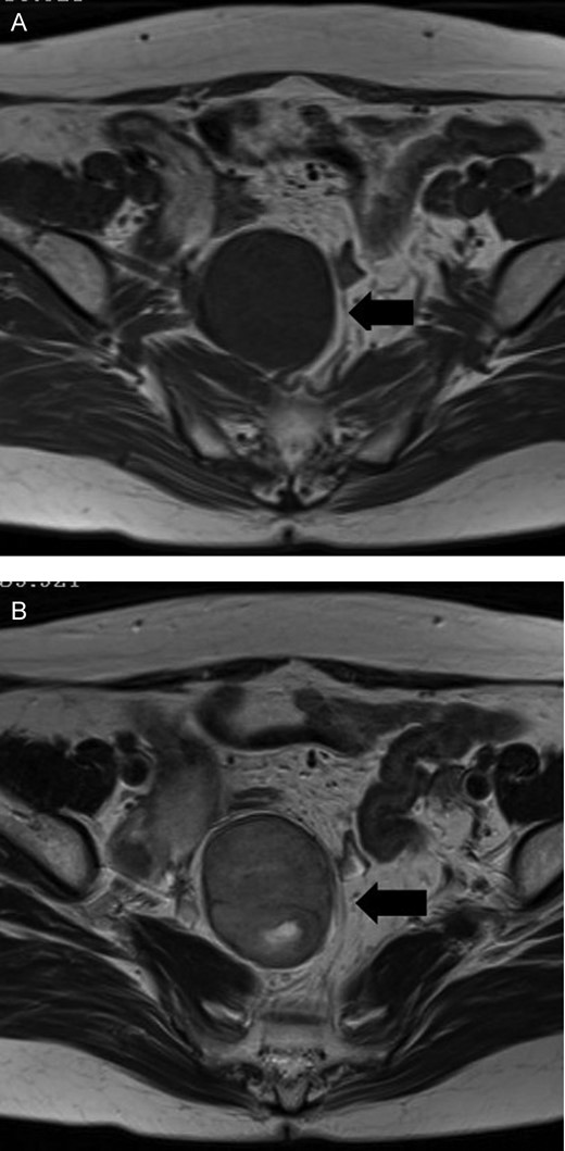 MRI shows that the tumor is a homogeneous hypointensity on T1-weighted images (A) and a heterogeneous slight hyperintensity on T2-weighted images (B) in a right side of the pelvic cavity.