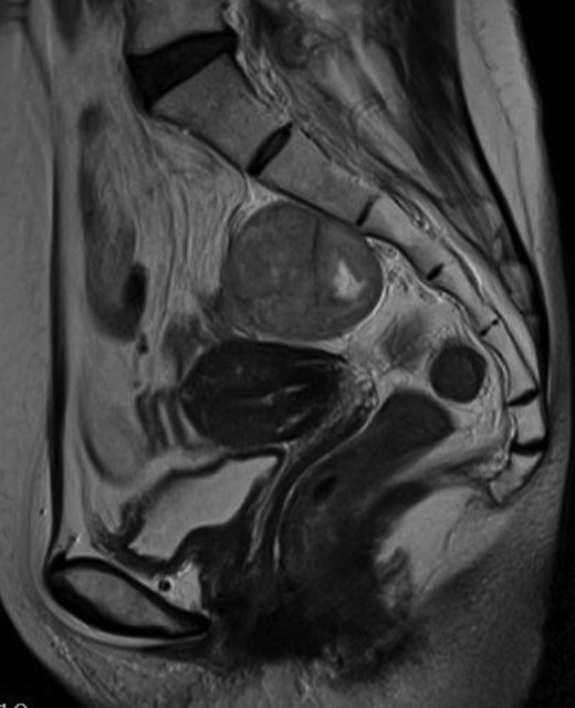 Sagittal MRI sections show the mass to be intricately related to the anterior presacral fascia.