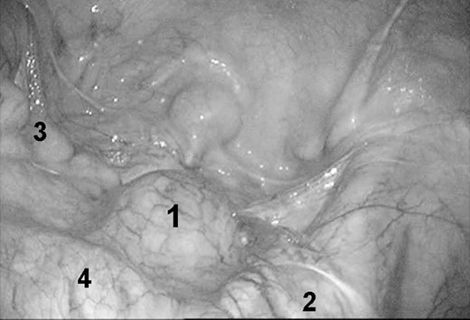 Laparoscopic findings of schwannoma in the pelvis. 1, schwannoma 2, right ureter 3, rectum 4, right iliac vessel.