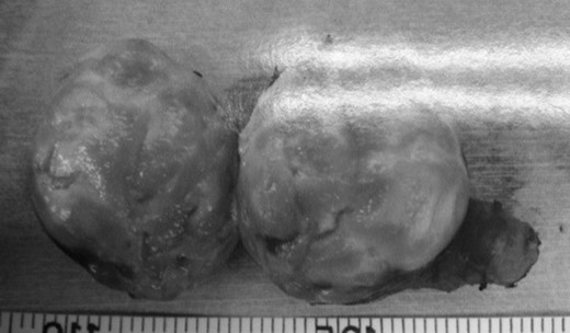 The specimen is an elastic hard, 5 × 4 cm mass with an integral envelope. On sectioning, it is yellow and white in color, predominantly solid with cystic change.