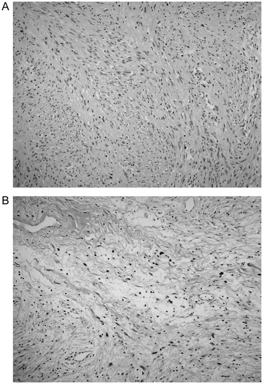 Histologic findings of schwannoma in the pelvis (hematoxylin and eosin, ×200). (A) The Antoni A pattern is composed of spindle cells arranged in intersection fascicles. Nuclear palisades are seen and mitoses are rarely observed. (B) The Antoni B pattern is composed of loose hypocellular tissue.