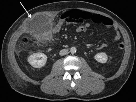An axial CT with contrast showing the RUQ appendiceal abscess.