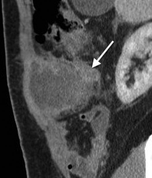 A coronal CT with contrast showing the tail of the appendix communicating with the appendiceal abscess.