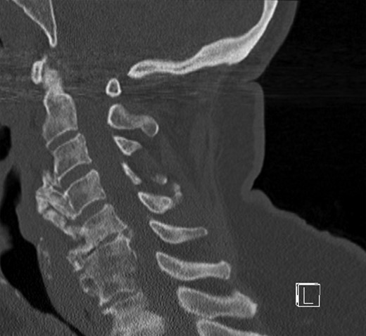 CT of the cervical spine in a sagittal view. Osteophytes of the ventral cervical spine segments C3–C5 protrude towards the oesophageal lumen.