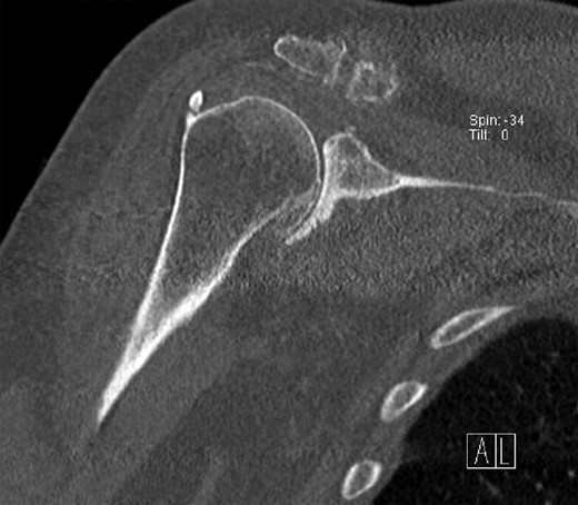 CT of the right shoulder in a coronary plane. Hyperostosis is present at the medial side of the humeral head, as well as at the humeral insertion of the rotator cuff.