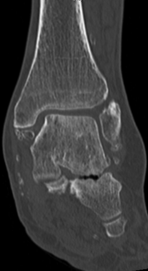 CT of the left ankle in a coronary plane. Ossification is present in the deltoid ligament. The tibiotalar and talocalcaneal joints show Kellgren grade 4 arthrosis.