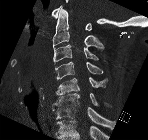 CT of the cervical spine in a sagittal view. Osteophytes from C3 to C5 are removed. Sagittal alignment of the spine is preserved.