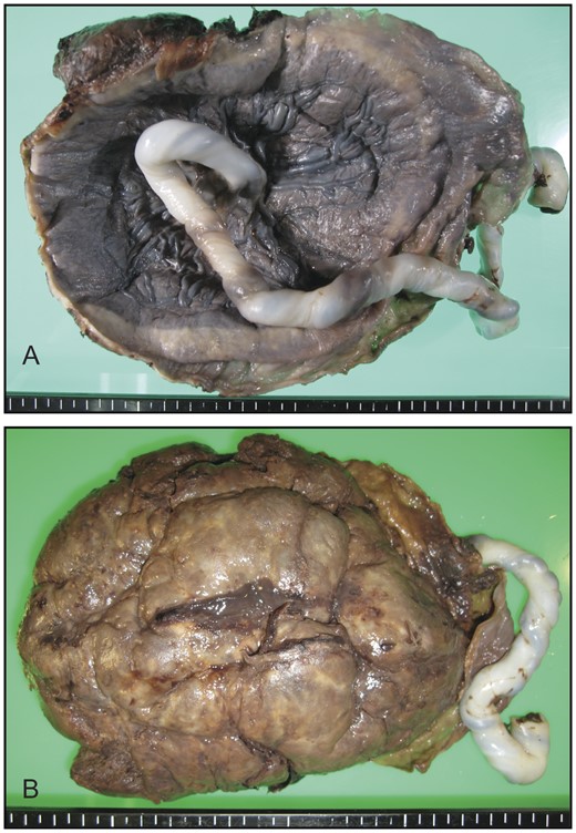 Gross appearance of the formalin-fixed placenta, viewed from the fetal side (A) and the maternal side (B). No macroscopic abnormalities were detected.