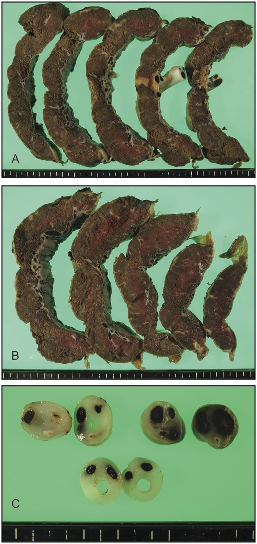 Cross-sectional views of the formalin-fixed placenta. (A and B) Focal infarct was detectable immediately beneath the site of umbilical cord insertion. (C) Cross sections of the umbilical cord depicted no structural abnormalities.