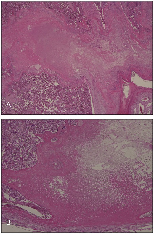 Histologic images corresponding to the placental infarcts shown in Fig. 2A.