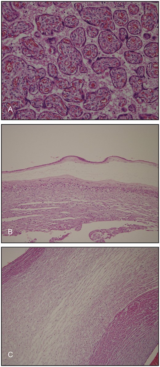 Microscopic images of the villous structures. The villi were of appropriate maturity for gestational age and the villous vessels showed no structural abnormalities (A). Histopathology revealed no signs of chorioamnionitis (B) or funisitis (C).