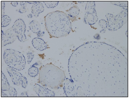 Immunohistochemistry showing minimal positivity for complement split fraction C4d.