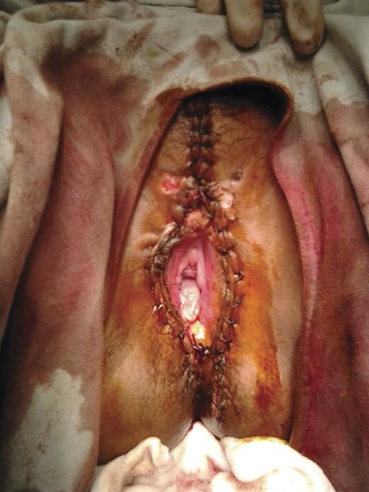 A post-operative picture.