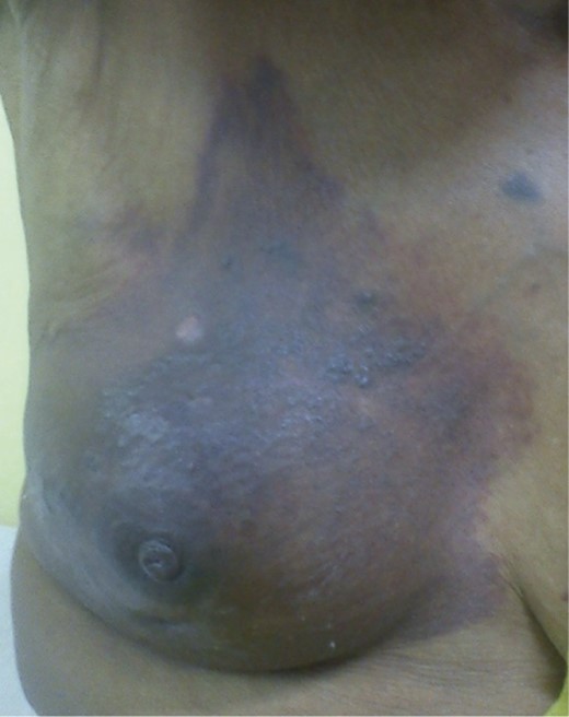 Right breast lump with diffuse pigmentation.