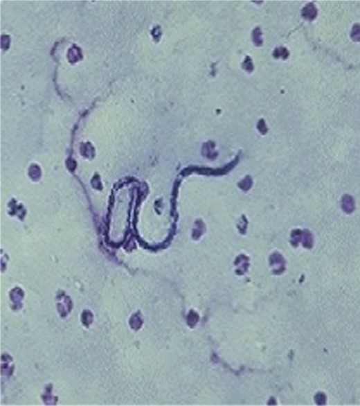 FNAC showing W. bancrofti against a hemorrhagic background.