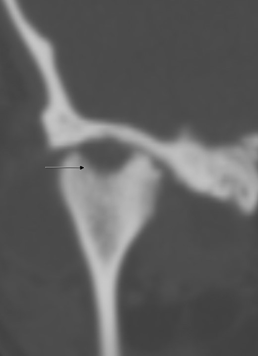 CT scan of the head (coronal section), arrow indicates osteolysis of the right condylar head.