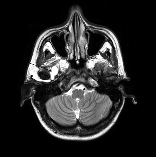 MRI scan, the arrows point out the huge effusion medial and lateral of the right TMJ.